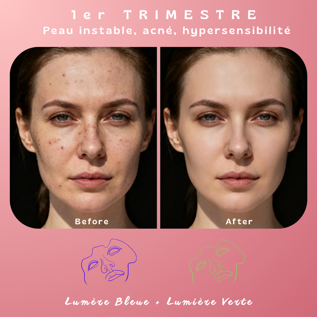 Masque de luminothérapie LED Akna – Souple & apaisant