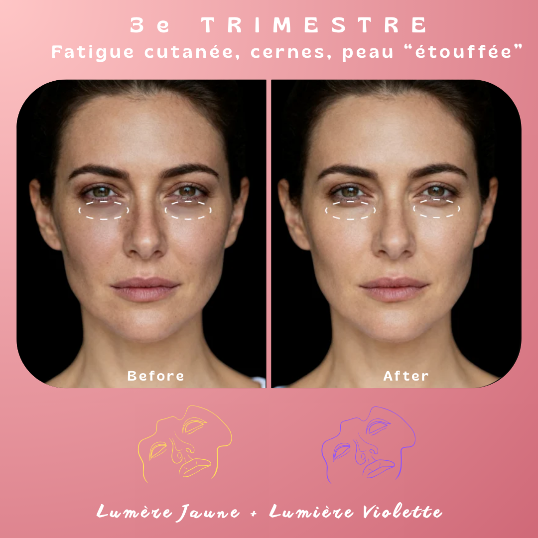 Masque de luminothérapie LED Akna – Souple & apaisant