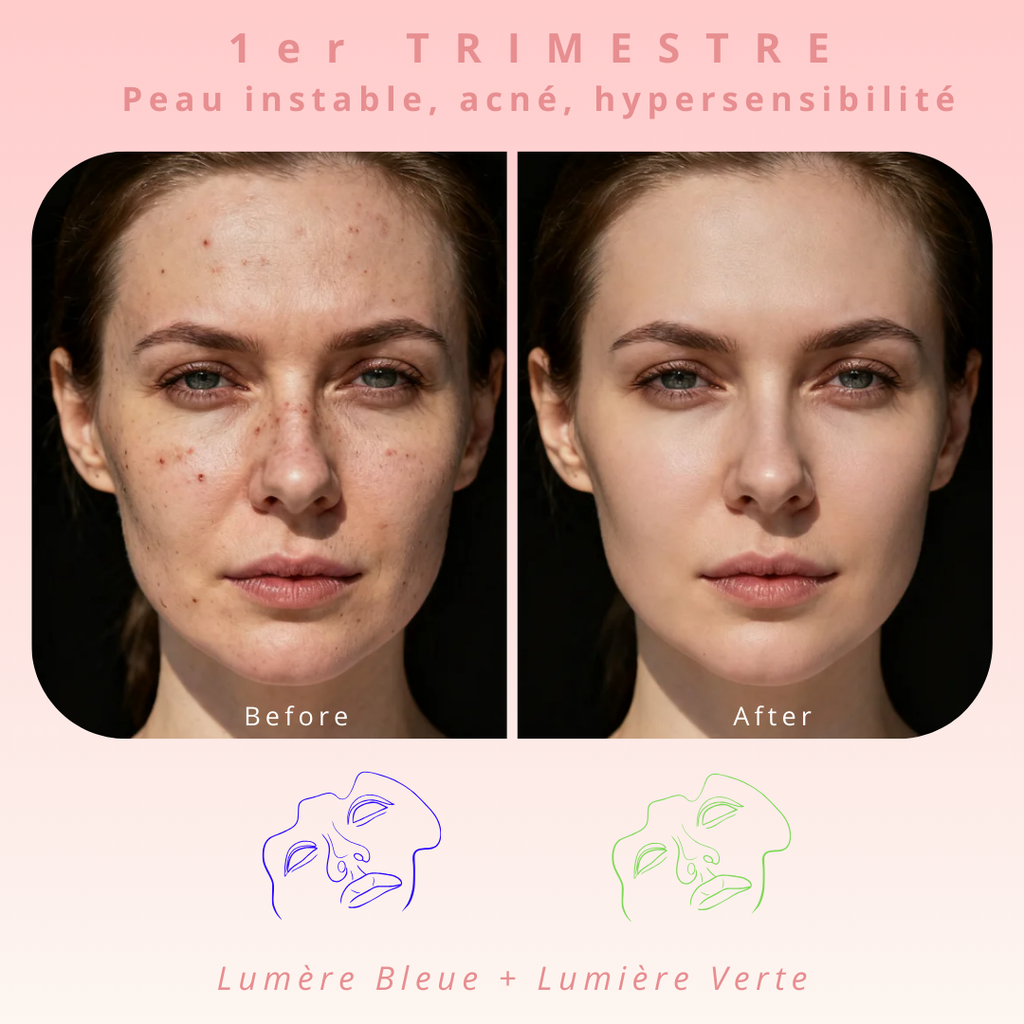 Masque de luminothérapie LED Akna – Souple