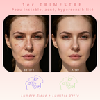 Masque de luminothérapie LED Akna – Souple