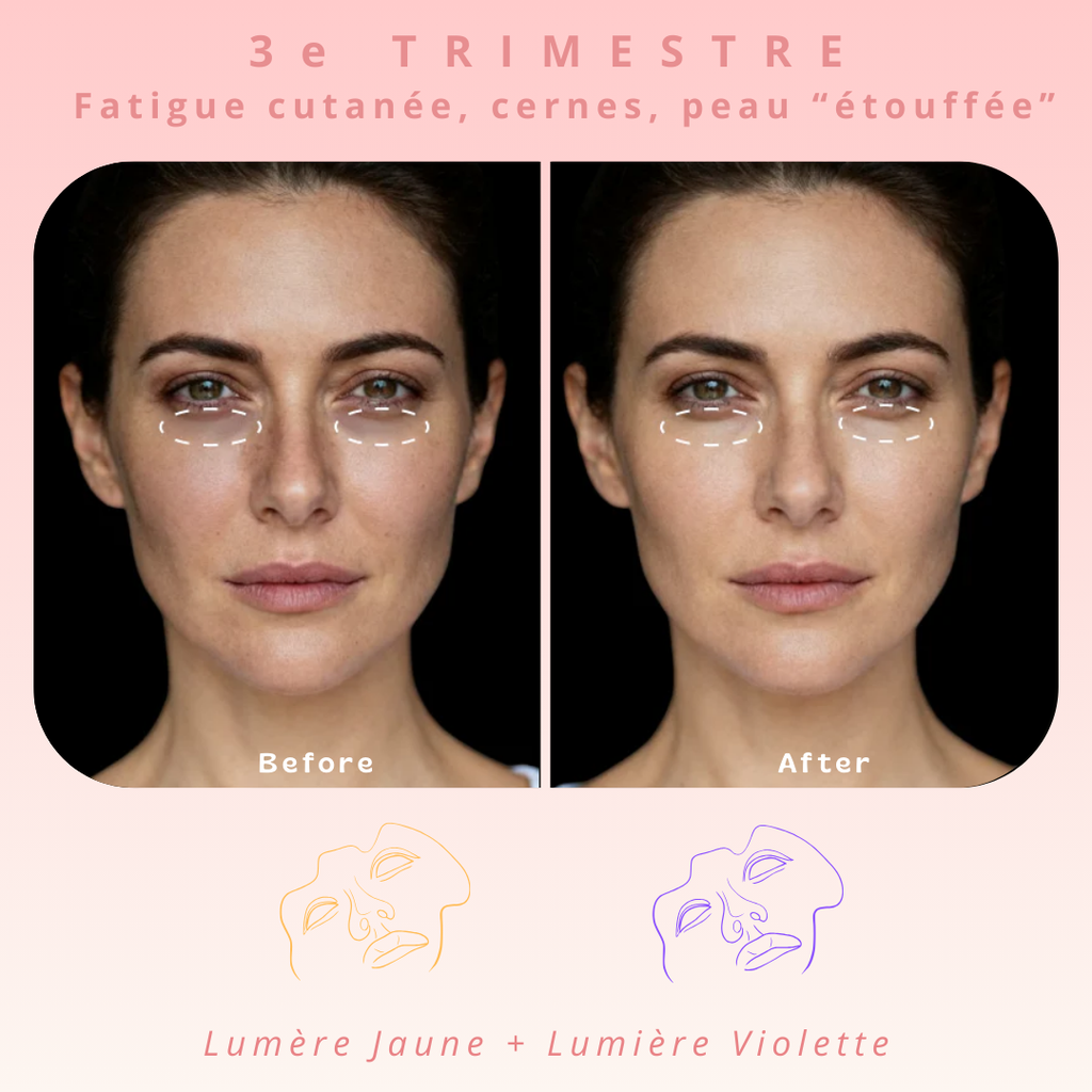 Masque de luminothérapie LED Akna – Souple