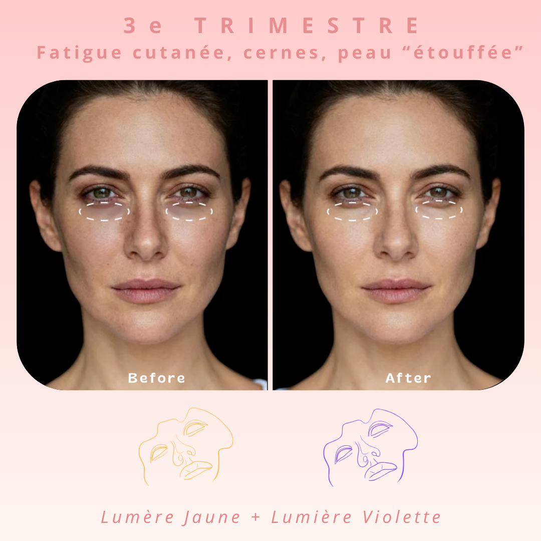 Masque de luminothérapie LED Akna – Souple